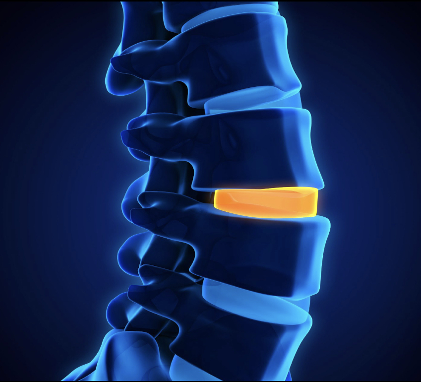 Enfermedad Degenerativa Del Disco ¿cuáles Son Las Opciones De Tratamiento 1929