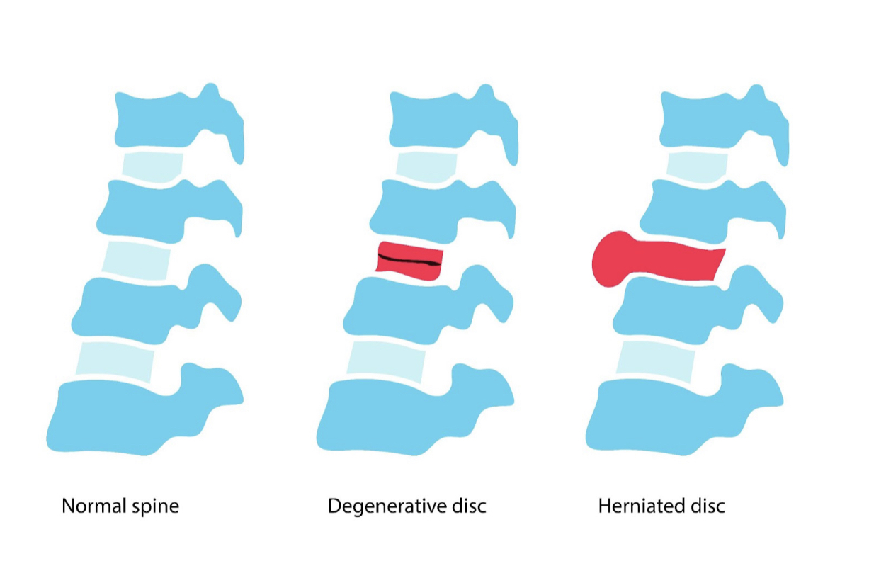Degenerative Disc Disease Symptoms, Diagnosis, and Treatment BEST