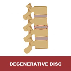 Headshot of Degenerative Disc Disease - Getting Effective Treatment