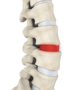 Headshot of Three Degenerative Disc Disease Treatment Options You May Have Overlooked