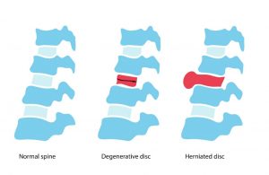 Headshot of Degenerative Disc Disease Symptoms, Diagnosis, and Treatment