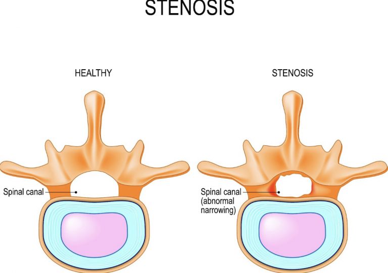 Estenosis foraminal