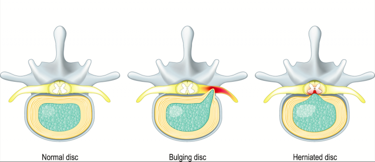 bulging-disc-and-herniated-disc-which-is-worse