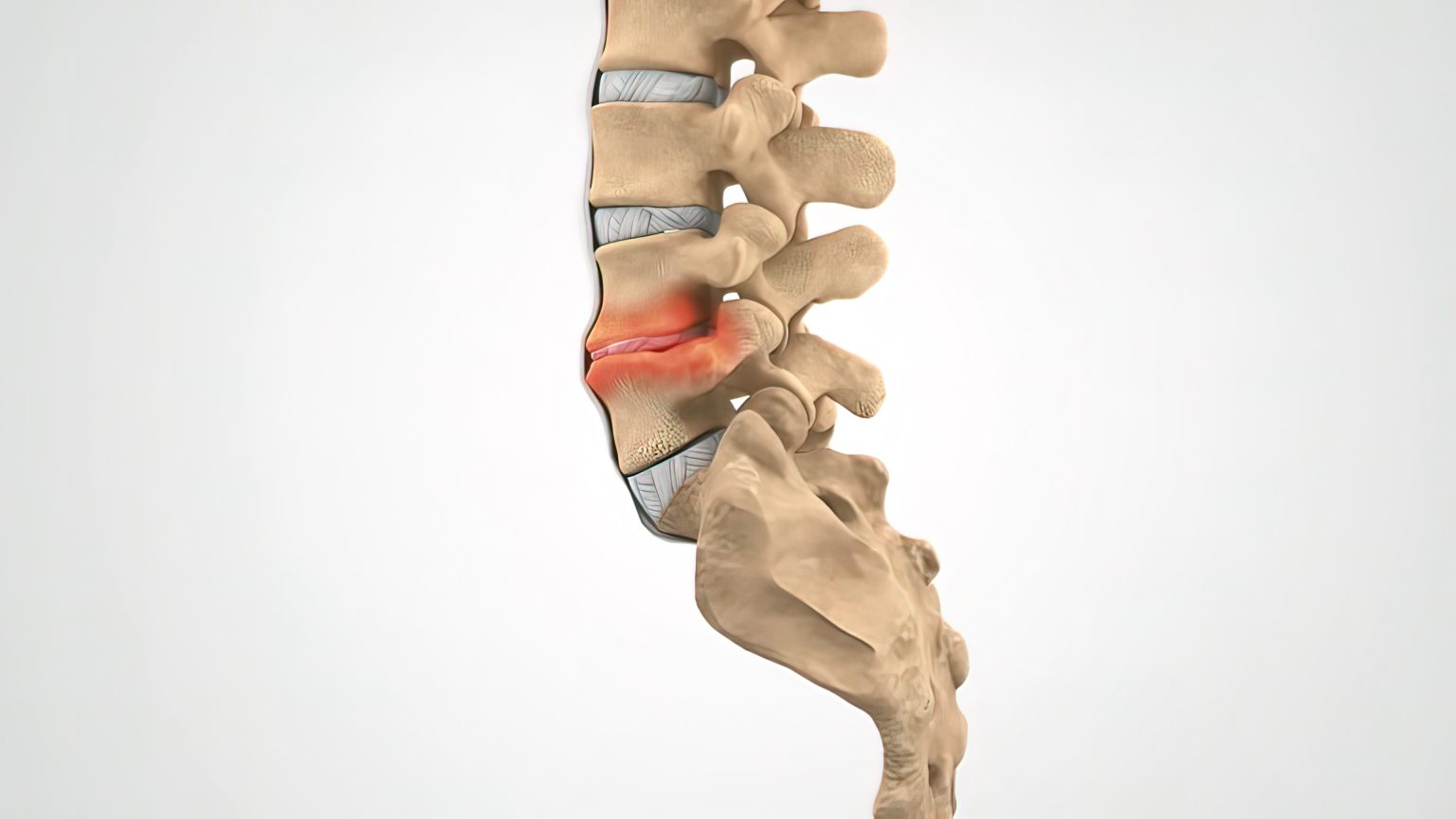 Vertebral Collapse and Collapsed Disc Main Differences BEST