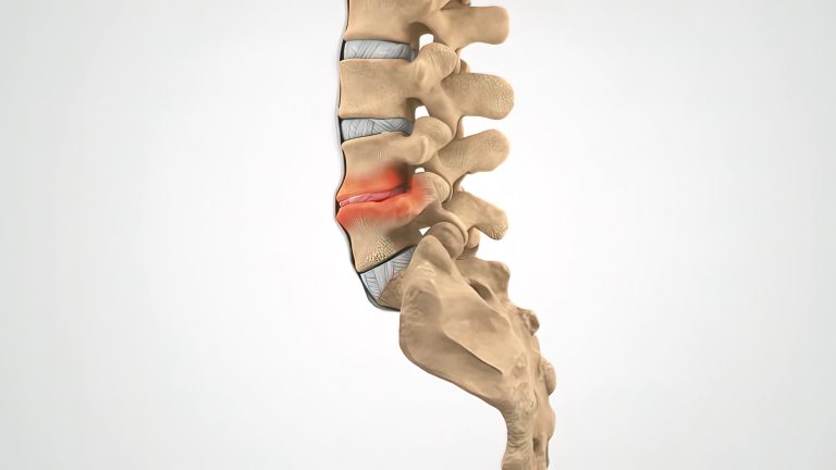 vertebral-collapse-and-collapsed-disc-main-differences